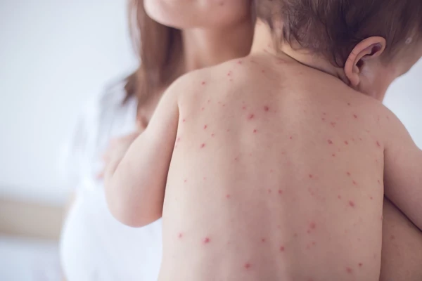 Take action to protect Oxfordshire from measles this summer!